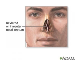 nasal obstruction