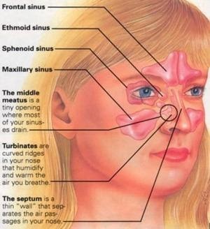maxillary and ethmoid sinus disease
