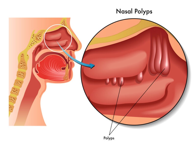 Breathing Problems Due To Nasal Polyps Southern California Sinus