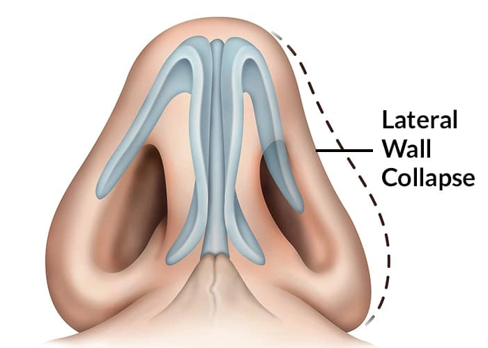 Lateral-Wall-Collapse